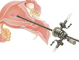 Миома матки гистероскопия. Гистерорезектоскопия миомы матки. Гистерорезектоскопия резекция эндометрия. Гистерорезектоскопия полипа эндометрия.